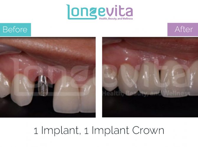 implant-crown-turkey-before-and-after-1-670x500
