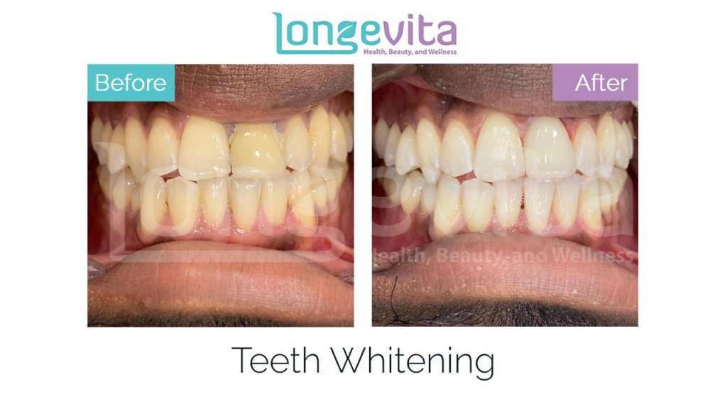teeth-whitening-before-after-3
