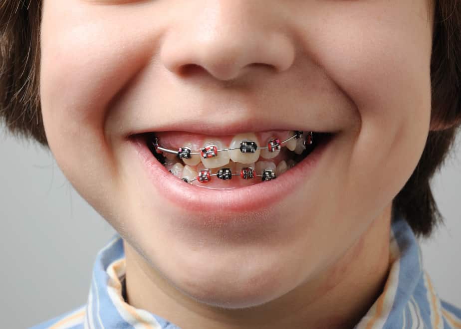 braces wearing child