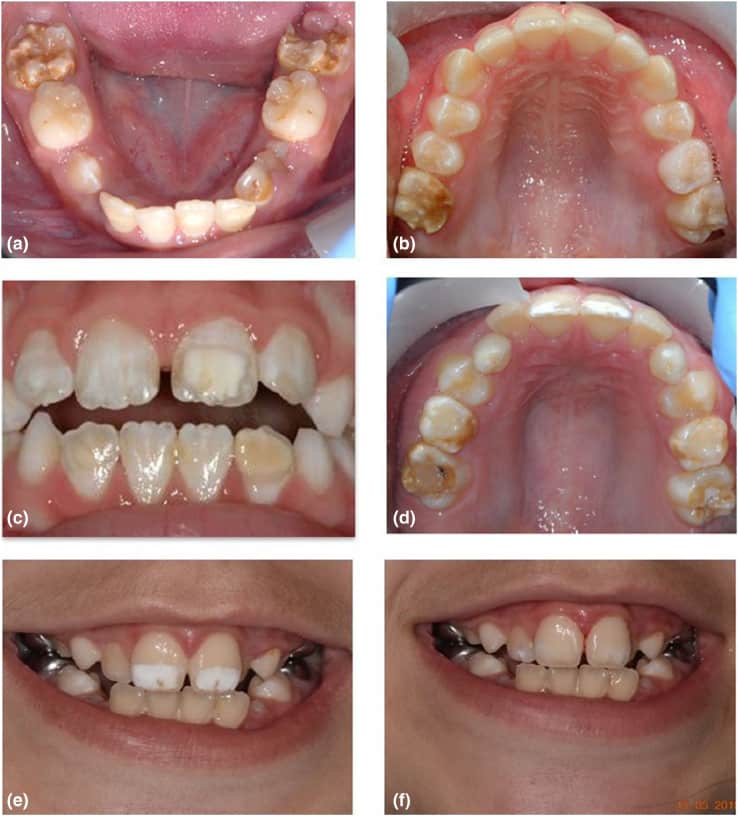 molar incisor hypomineralisation